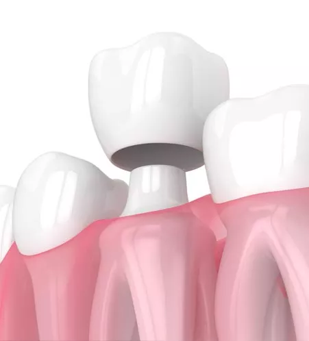 Illustration of a dental crown