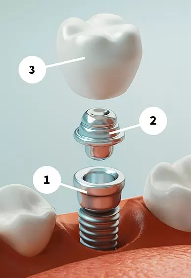 Parts of a dental implant